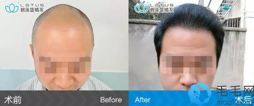 毛囊已经坏死，那么你想改善自己的脱发情况，一般需要进行植发手术