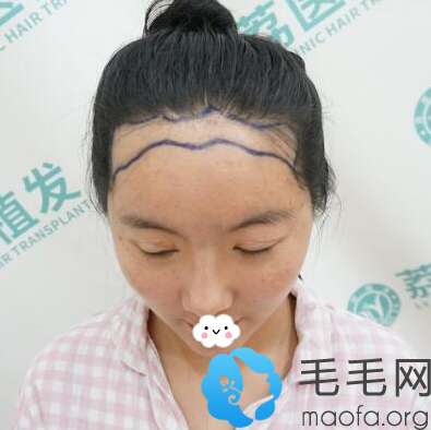 相信广州荔医的实力找尚俊做了发际线种植，来看看效果图