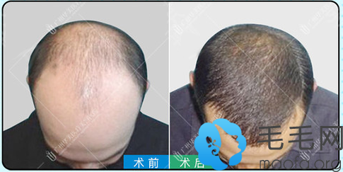 广州华美微针植发头顶加密术后效果图