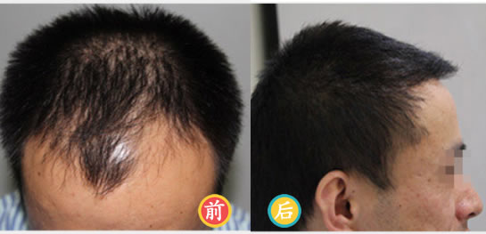 男子5个月前在海口华美医院进行种植发际线了,植发效果揭晓