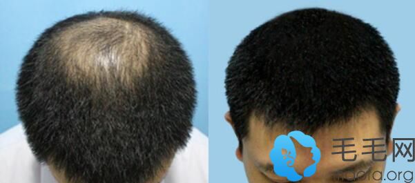 男士在广州曙光做头发旋处稀疏加密种植案例
