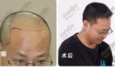 给大家展示m型发际线的男生在上海植发4000单位效果图