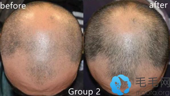 非那雄胺治疗脱发前后效果对比照片