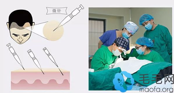 微针植发手术过程图解