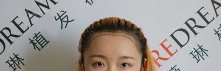 想知道杭州薇琳头发种植技术好吗?看我的美人尖种植效果图