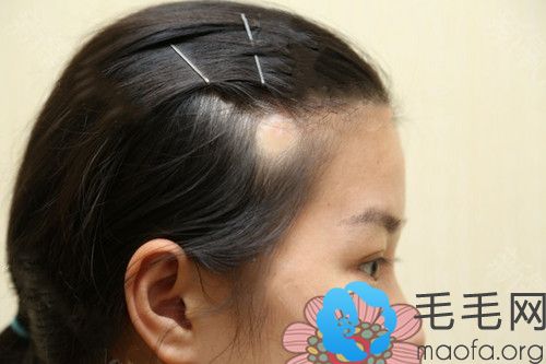 在深圳非凡植发做了额角种植来分享下我额角脱发恢复案例
