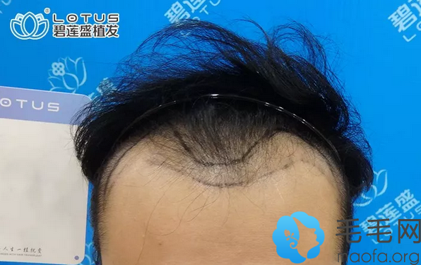 在西安碧莲盛植发2700单位9个月额角脱发的地方终于长头发了
