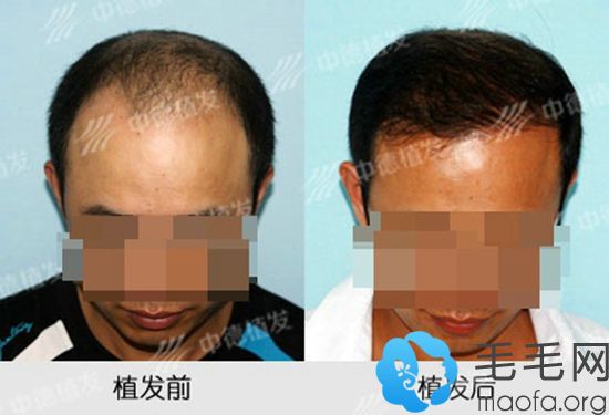 北京中德头发加密种植案例