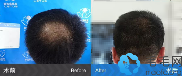 头顶头发加密种植5个月效果对比图