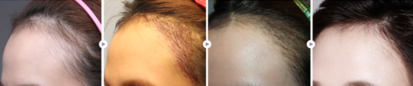 毛杰琳种植发际线的时候保留毛绒碎发更自然