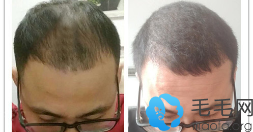 头发稀疏加密后半年的效果对比图