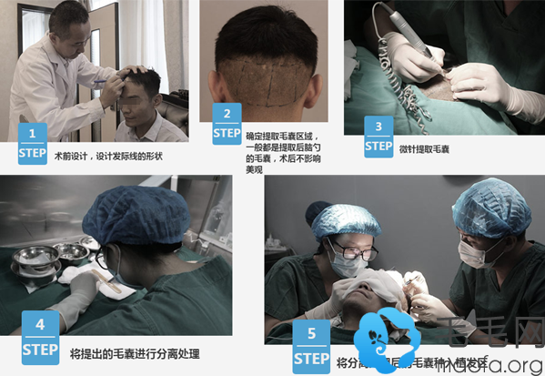 李海燕植发手术过程