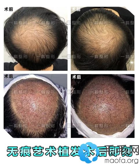 遗传性脱发通过植发后长出头发