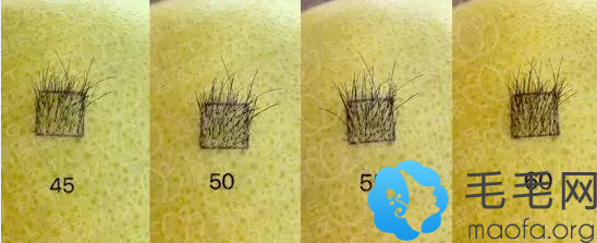 45-60密度的植发效果