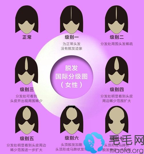 女性1-7级脱发分级图