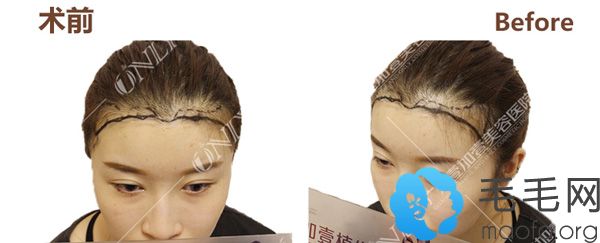晒晒我的植发效果图,大家看我在广州植发际线花一万多贵不