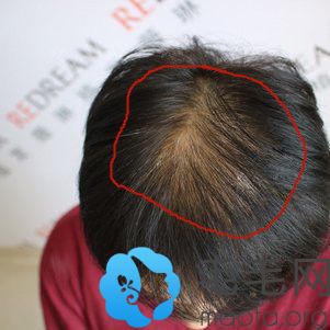 女性头顶脱发稀疏加密术前照片