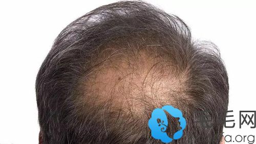 慢性脂溢性脱发怎么治疗