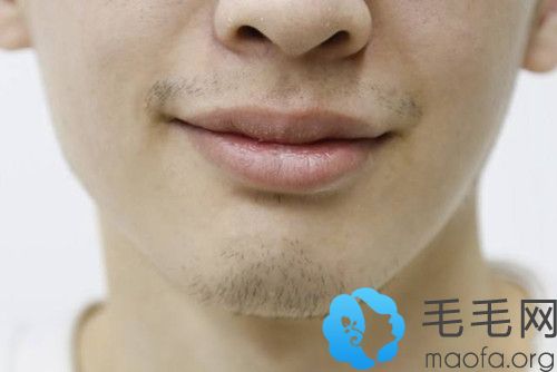 【涨姿势】种植胡子需要多少毛囊单位、价格一般要多少钱?