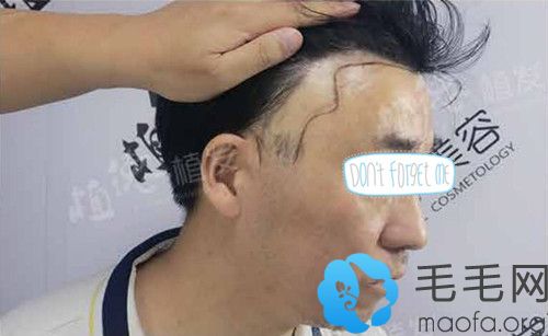 广州天河区植德植发疤痕植发术前照片