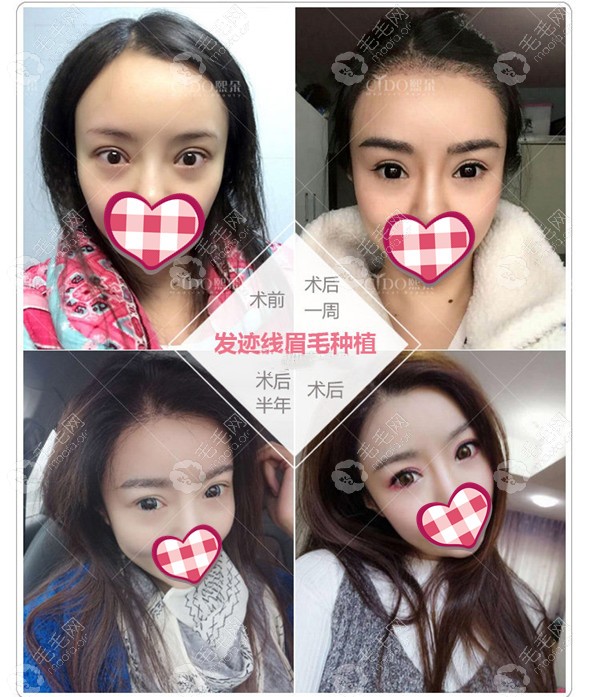 眉毛种植后能维持几年?她在北京熙朵植眉1年效果还挺好的