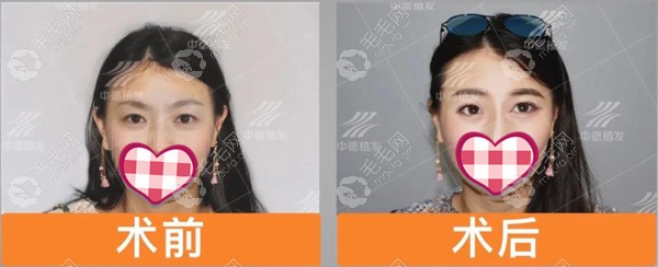 北京中德植发医院的毛囊种植睫毛手术对比效果图来了