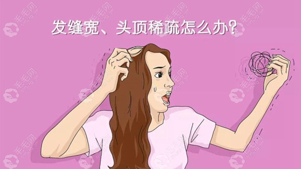 童靖用微针点阵加密植发技术来治疗女性头顶发缝稀疏脱发